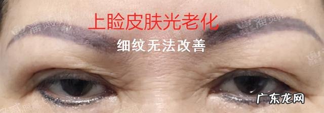 割双眼皮注意啥 割双眼皮以后注意什么