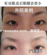 割双眼皮注意啥 割双眼皮以后注意什么