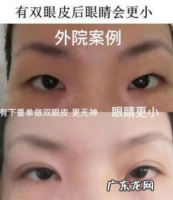 割双眼皮注意啥 割双眼皮以后注意什么
