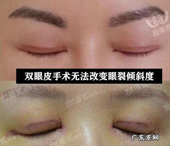 割双眼皮注意啥 割双眼皮以后注意什么