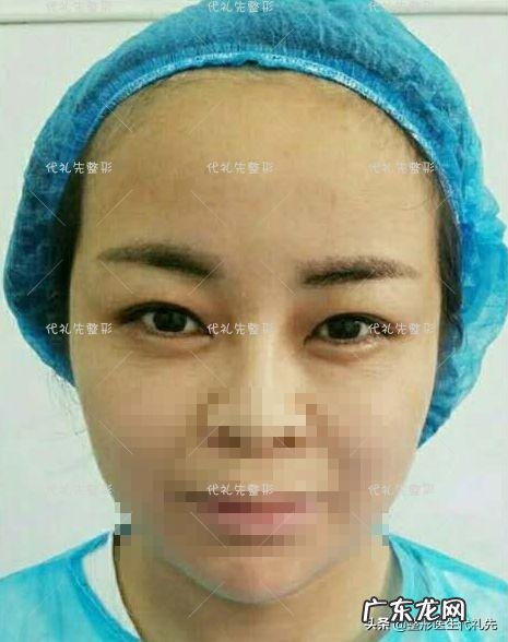 30多岁做全切的双眼皮好吗 五年前全切过双眼皮现在还能做吗