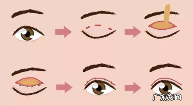 做双眼皮其实很简单 做双眼皮是怎么做得更好