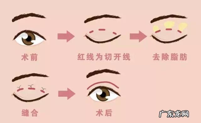 做双眼皮其实很简单 做双眼皮是怎么做得更好