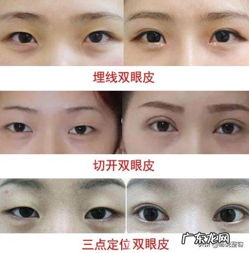 双眼皮手术当天准备什么 双眼皮手术前必须知道什么
