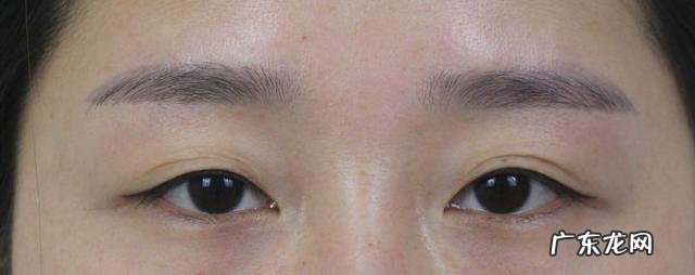 双眼皮是割还是埋线好 双眼皮手术是埋线好还是全割好