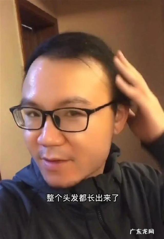 6年不用洗发水实测 男子秃顶后坚持半个月不用洗发水