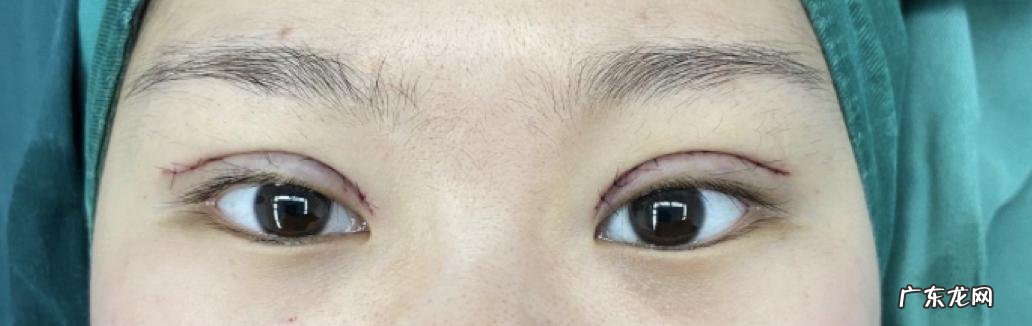 双眼皮手术 双眼皮手术有几种做法
