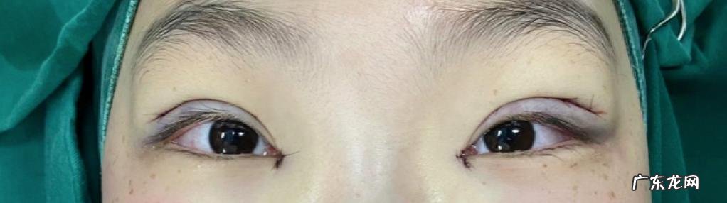 双眼皮手术 双眼皮手术有几种做法