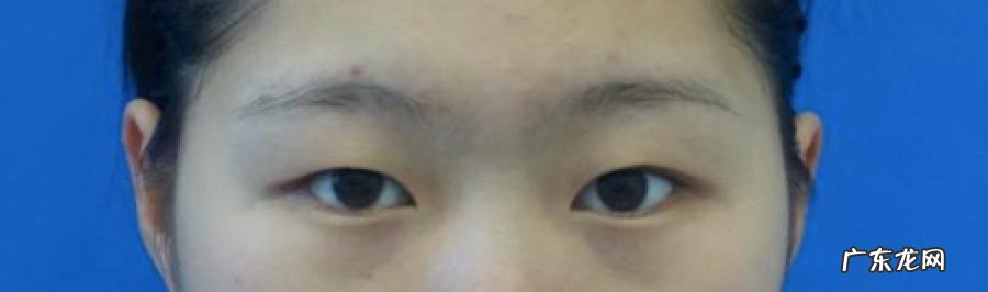 双眼皮手术 双眼皮手术有几种做法