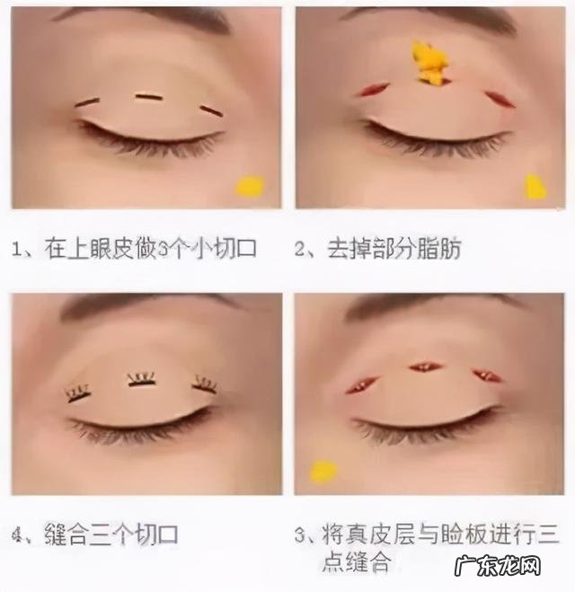 双眼皮手术现在值不值得做 双眼皮手术并不是简单的一刀切