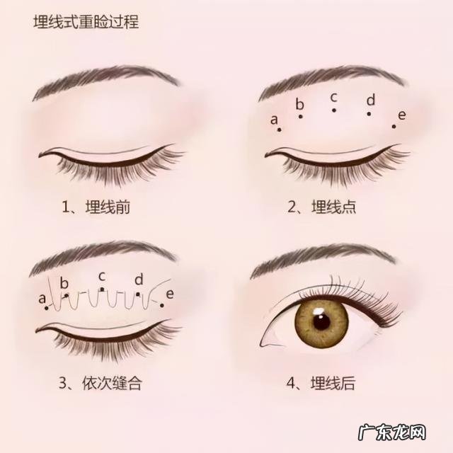 双眼皮手术现在值不值得做 双眼皮手术并不是简单的一刀切