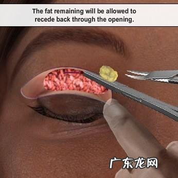 平扇双眼皮和开扇哪个更自然 哪种双眼皮手术最自然