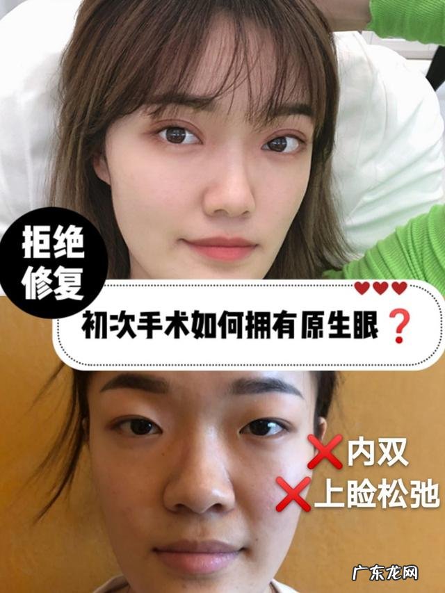 田国静修复6次失败双眼皮 双眼皮失败修复手术成功真实案例