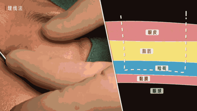 双眼皮手术一年的经验 双眼皮手术经验分享