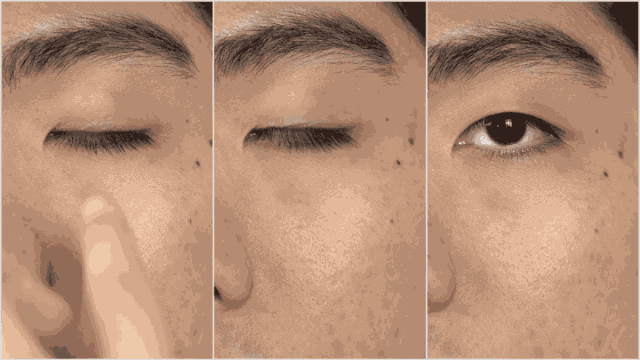 双眼皮手术一年的经验 双眼皮手术经验分享