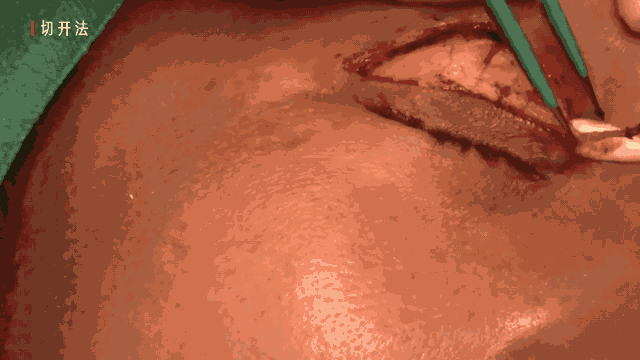 双眼皮手术一年的经验 双眼皮手术经验分享