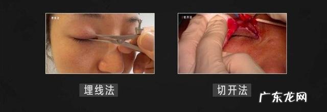 双眼皮手术一年的经验 双眼皮手术经验分享
