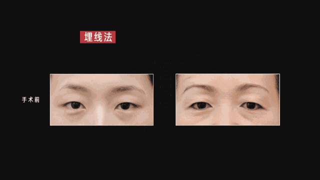 双眼皮手术一年的经验 双眼皮手术经验分享