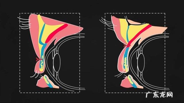 双眼皮手术一年的经验 双眼皮手术经验分享
