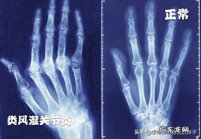 婴幼儿大拇指腱鞘炎需要手术吗?需要注意些什么?