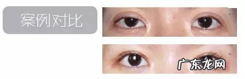 双眼皮的手术步骤图 双眼皮手术全过程