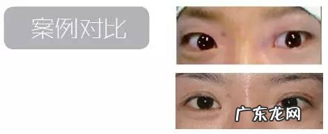 双眼皮的手术步骤图 双眼皮手术全过程