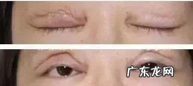 双眼皮太宽能修复吗 双眼皮做太宽能修复吗