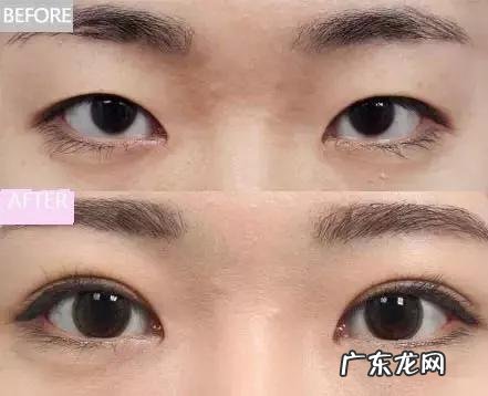 双眼皮太宽能修复吗 双眼皮做太宽能修复吗
