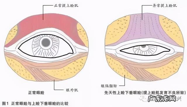 双眼皮二次修复是重新做么 双眼皮修复是重新割一个双眼皮吗