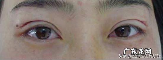 全切双眼皮有啥弊端 全切双眼皮的优缺点