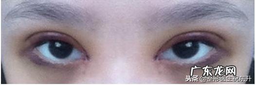 全切双眼皮有啥弊端 全切双眼皮的优缺点