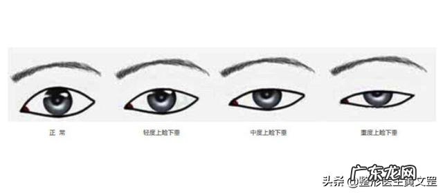 全切双眼皮和眼综合哪个损伤大 双眼皮全切和眼综合有什么区别