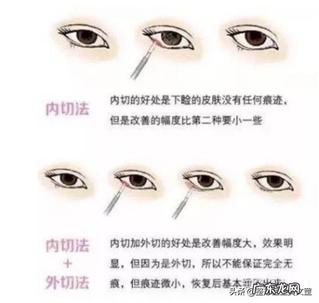 全切双眼皮和眼综合哪个损伤大 双眼皮全切和眼综合有什么区别