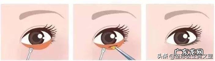 全切双眼皮和眼综合哪个损伤大 双眼皮全切和眼综合有什么区别