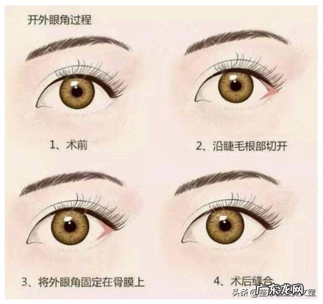 全切双眼皮和眼综合哪个损伤大 双眼皮全切和眼综合有什么区别