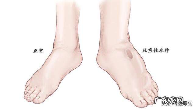 孕期为什么会水肿怎么缓解呀