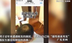 怎么治疗轻度秃头 怎么治愈秃头