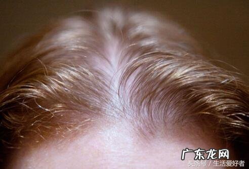 男士掉头发的解决方法 治脱发生发的简单有效方法