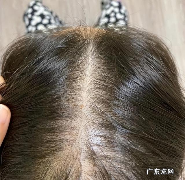 排名第一的生发液 生发液真实测评推荐