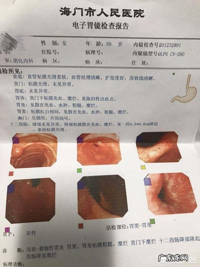 糜烂性胃炎应该如何zhi疗?