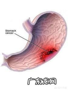 糜烂性胃炎应该如何zhi疗?