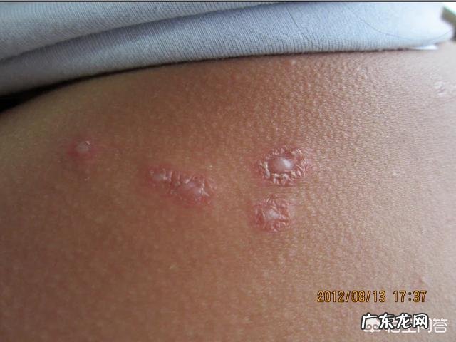 带状疱疹患者的饮食禁忌有哪些?