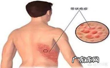 带状疱疹患者的饮食禁忌有哪些?