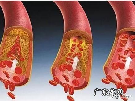 脑供血不足，会有什么表现怎么改善