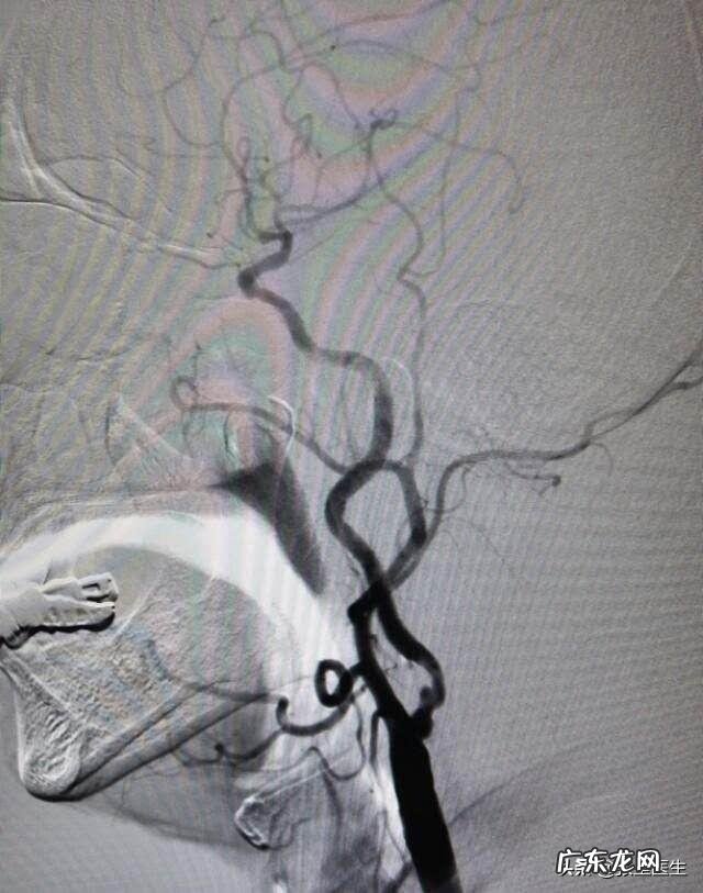 脑供血不足，会有什么表现怎么改善
