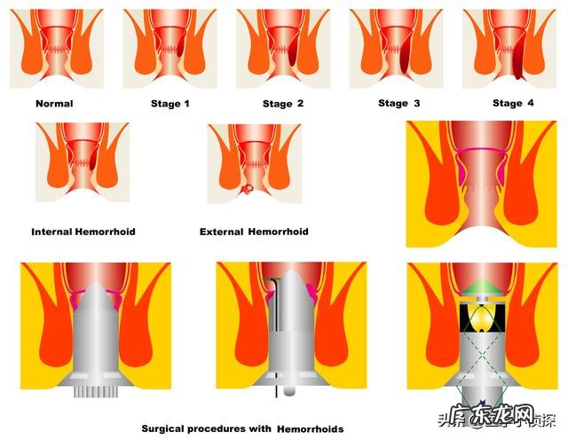 会不会后悔做过痔疮手术?