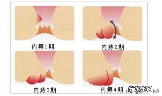 会不会后悔做过痔疮手术?