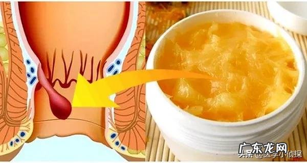 会不会后悔做过痔疮手术?