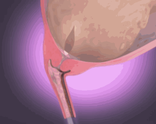 怀孕臃肿怎么办?有什么好的消肿方法吗?