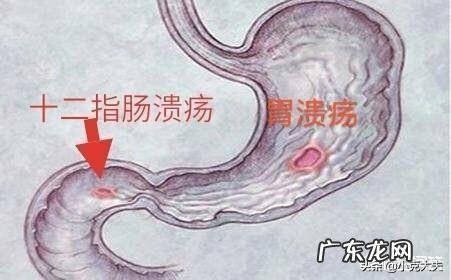 之前有十二指肠溃疡,过后怎样调理肠胃